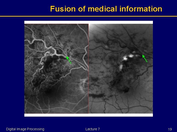 Fusion of medical information Digital Image Processing Lecture 7 19 