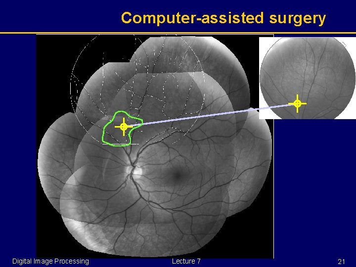 Computer-assisted surgery Digital Image Processing Lecture 7 21 