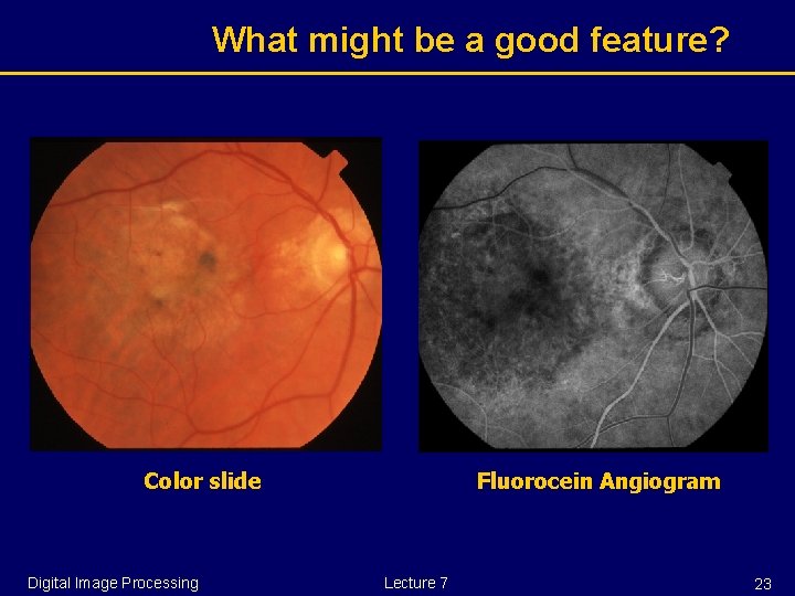 What might be a good feature? Color slide Digital Image Processing Fluorocein Angiogram Lecture