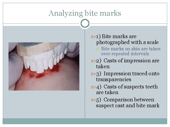 Analyzing bite marks 1) Bite marks are photographed with a scale Bite marks on