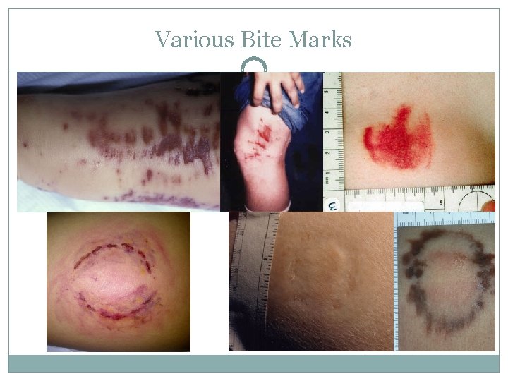 Various Bite Marks 