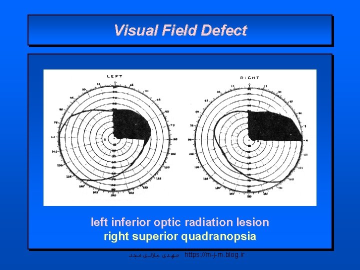 Visual Field Defect left inferior optic radiation lesion right superior quadranopsia ﻣﻬﺪی ﺟﻼﻟی ﻣﺠﺪ