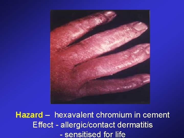 Hazard – hexavalent chromium in cement Effect - allergic/contact dermatitis - sensitised for life