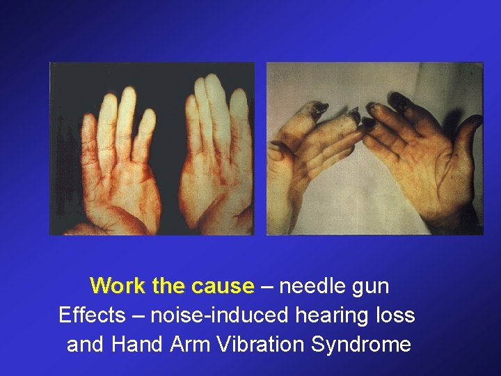 Work the cause – needle gun Effects – noise-induced hearing loss and Hand Arm