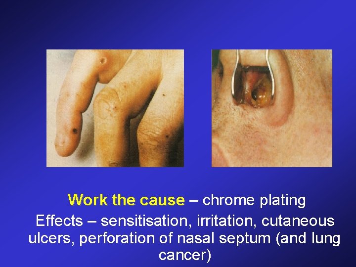 Work the cause – chrome plating Effects – sensitisation, irritation, cutaneous ulcers, perforation of
