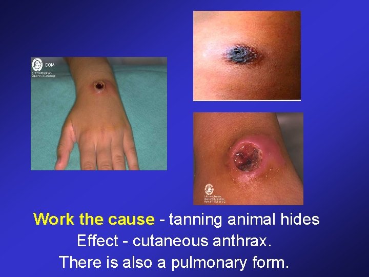 Work the cause - tanning animal hides Effect - cutaneous anthrax. There is also