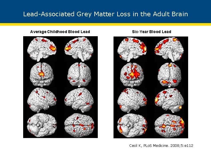 Lead-Associated Grey Matter Loss in the Adult Brain Average Childhood Blood Lead Six-Year Blood