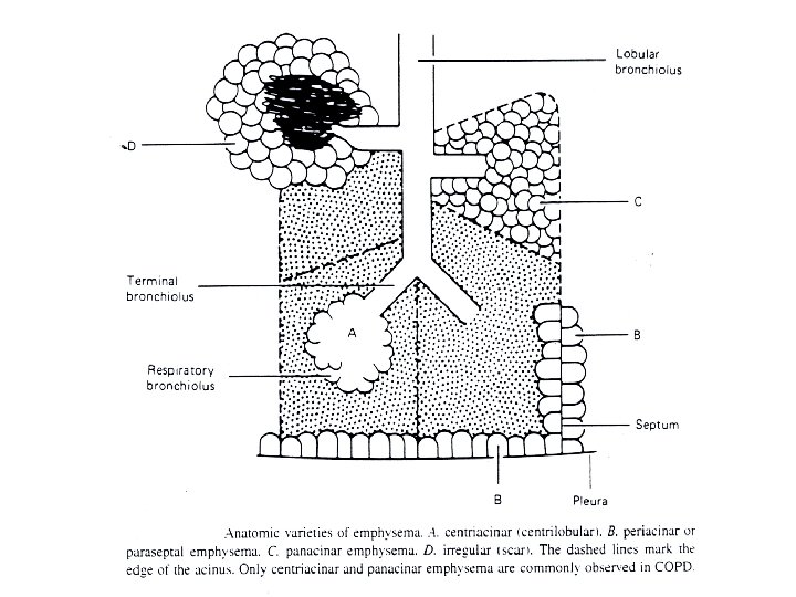 does lung cancer usually spread