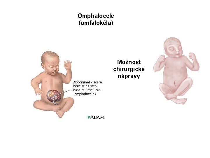 Omphalocele (omfalokéla) Možnost chirurgické nápravy 
