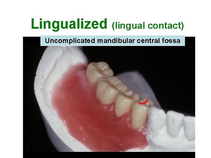 Lingualized (lingual contact) Uncomplicated mandibular central fossa 10 