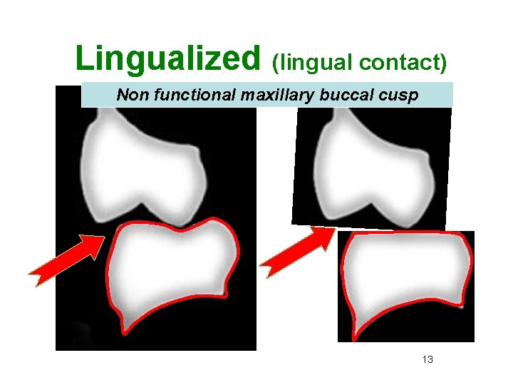 Lingualized (lingual contact) Non functional maxillary buccal cusp 13 