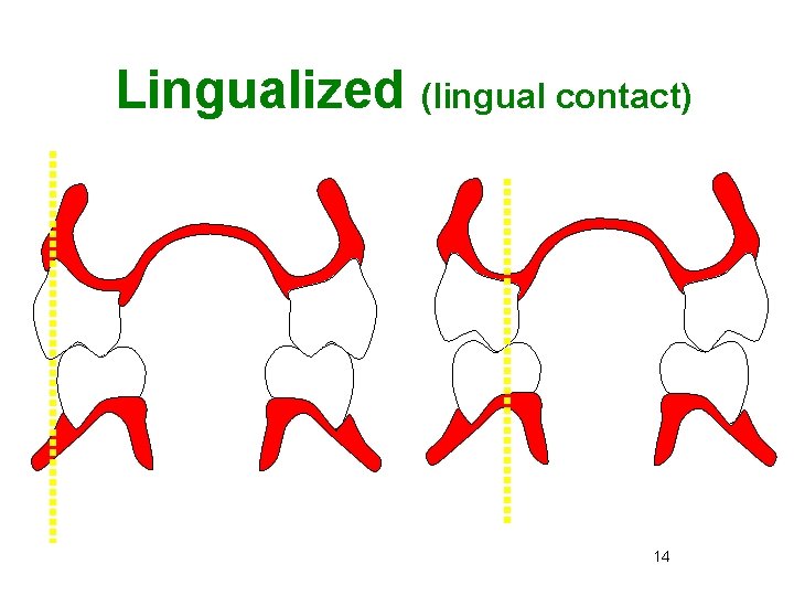 Lingualized (lingual contact) Anatomic Lingualized 14 