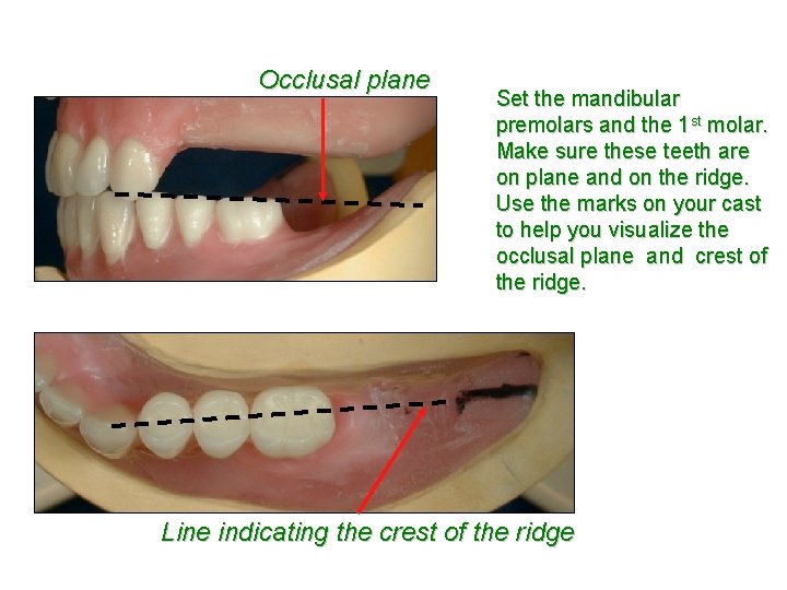 Occlusal plane Set the mandibular premolars and the 1 st molar. Make sure these