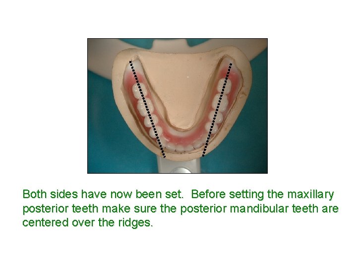 Both sides have now been set. Before setting the maxillary posterior teeth make sure