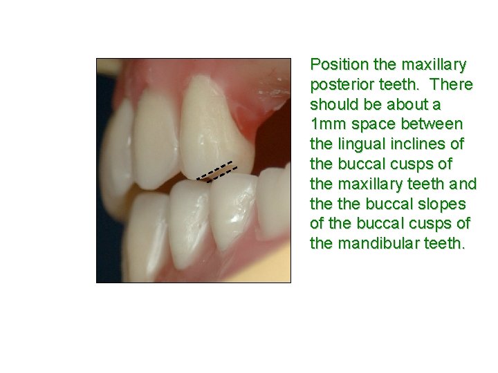 Position the maxillary posterior teeth. There should be about a 1 mm space between
