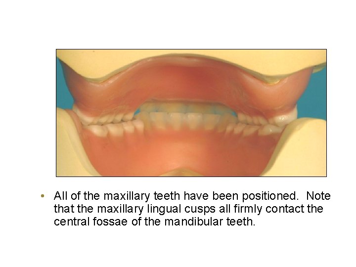  • All of the maxillary teeth have been positioned. Note that the maxillary