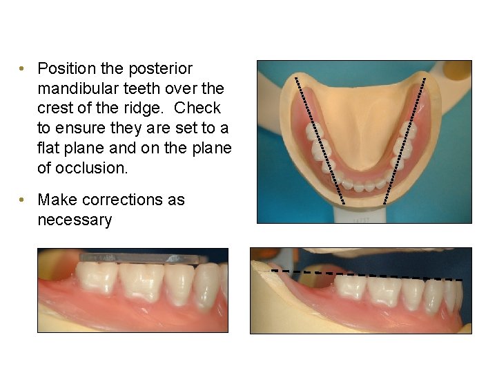  • Position the posterior mandibular teeth over the crest of the ridge. Check
