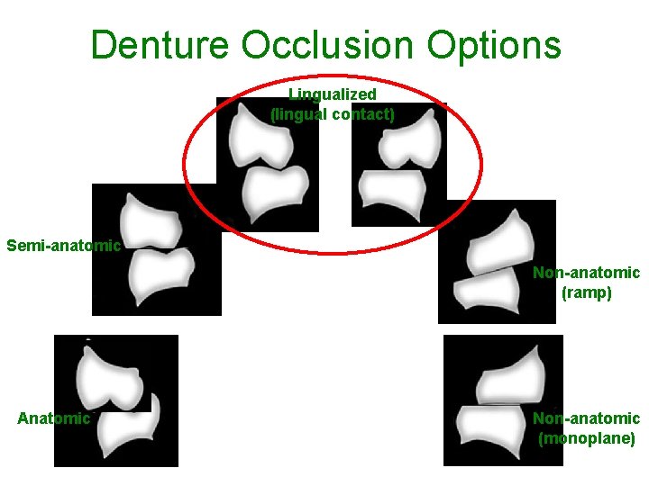 Denture Occlusion Options Lingualized (lingual contact) Semi-anatomic Non-anatomic (ramp) Anatomic Non-anatomic (monoplane) 7 