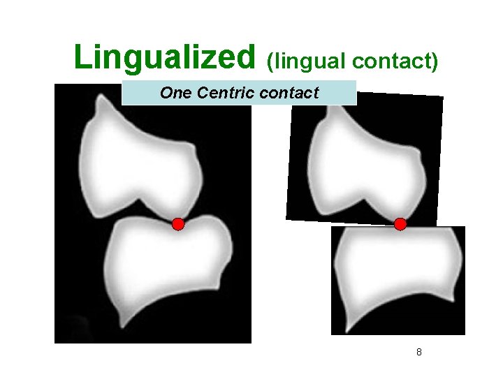 Lingualized (lingual contact) One Centric contact 8 