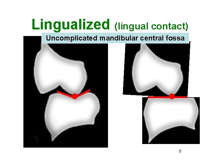 Lingualized (lingual contact) Uncomplicated mandibular central fossa 9 