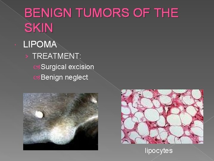 BENIGN TUMORS OF THE SKIN LIPOMA › TREATMENT: Surgical excision Benign neglect lipocytes 