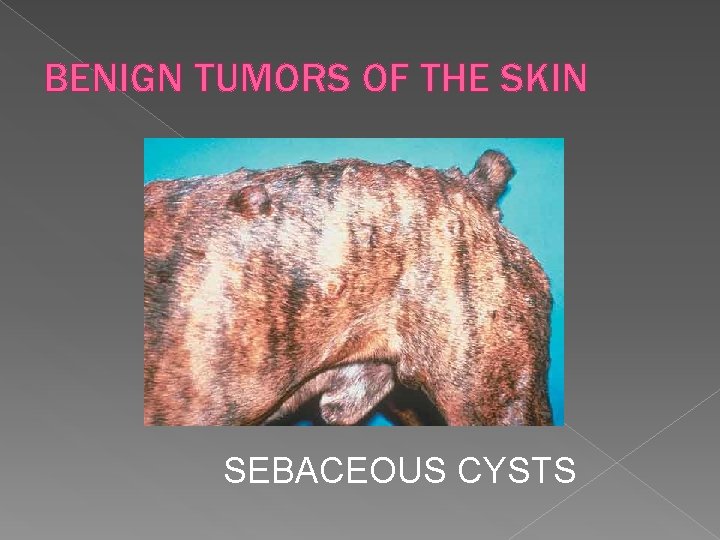 BENIGN TUMORS OF THE SKIN SEBACEOUS CYSTS 