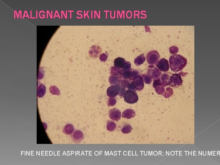 MALIGNANT SKIN TUMORS FINE NEEDLE ASPIRATE OF MAST CELL TUMOR; NOTE THE NUMER 