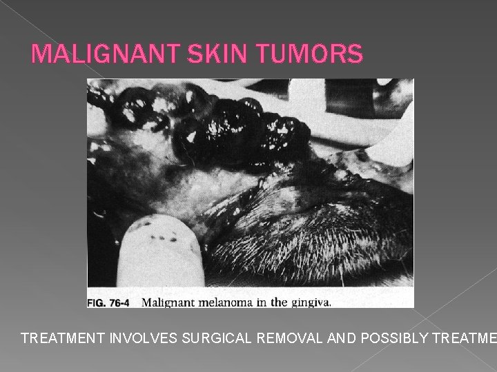 MALIGNANT SKIN TUMORS TREATMENT INVOLVES SURGICAL REMOVAL AND POSSIBLY TREATME 