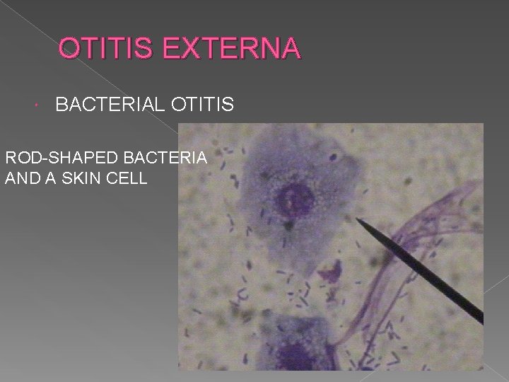 OTITIS EXTERNA BACTERIAL OTITIS ROD-SHAPED BACTERIA AND A SKIN CELL 