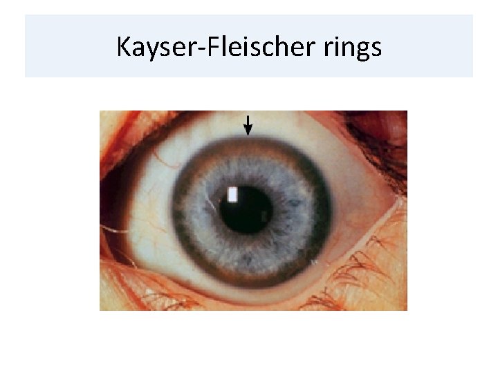 Kayser-Fleischer rings 
