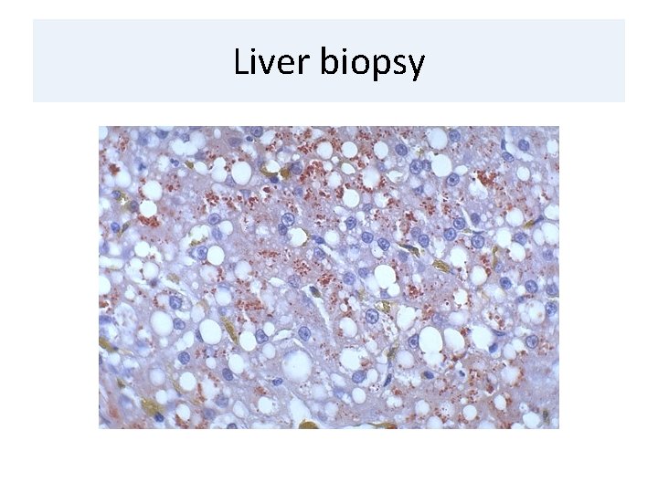 Liver biopsy 