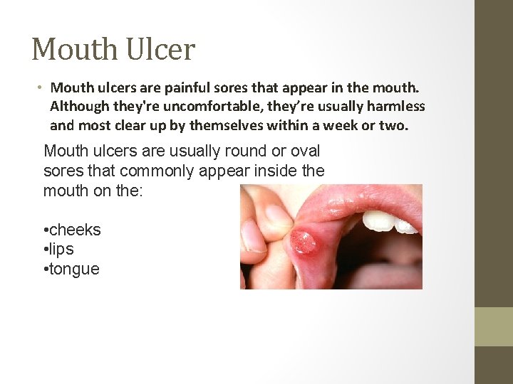 Mouth Ulcer • Mouth ulcers are painful sores that appear in the mouth. Although