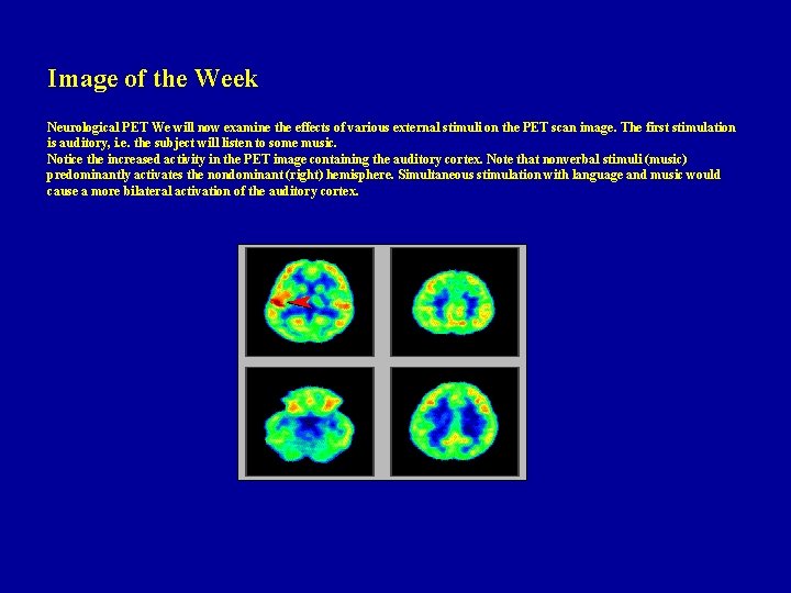 Image of the Week Neurological PET We will now examine the effects of various Image of the Week Neurological PET We will now examine the effects of various