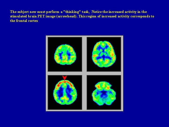 The subject now must perform a "thinking" task, Notice the increased activity in the The subject now must perform a "thinking" task, Notice the increased activity in the