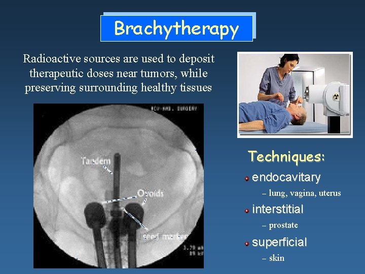 Brachytherapy Radioactive sources are used to deposit therapeutic doses near tumors, while preserving surrounding Brachytherapy Radioactive sources are used to deposit therapeutic doses near tumors, while preserving surrounding