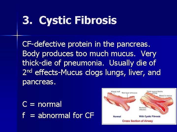 3. Cystic Fibrosis CF-defective protein in the pancreas. Body produces too much mucus. Very