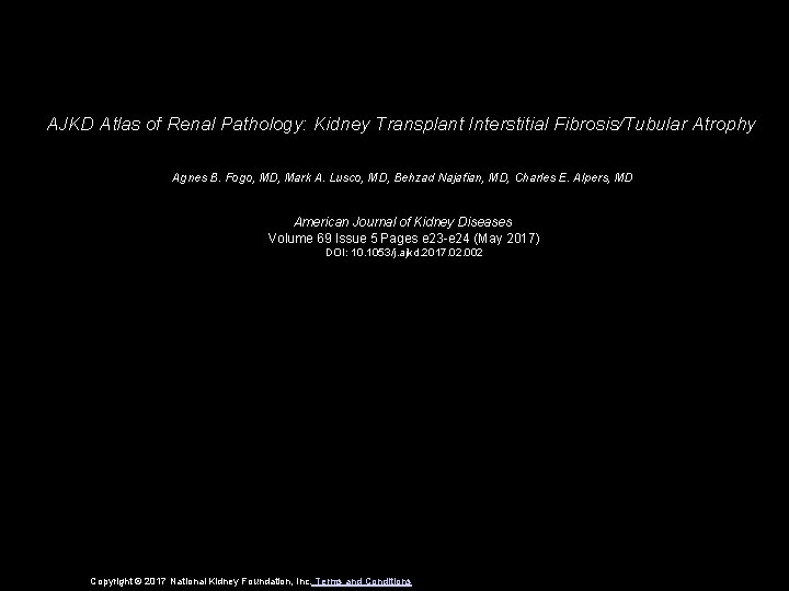 AJKD Atlas of Renal Pathology: Kidney Transplant Interstitial Fibrosis/Tubular Atrophy Agnes B. Fogo, MD,