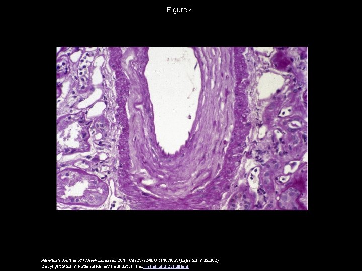 Figure 4 American Journal of Kidney Diseases 2017 69 e 23 -e 24 DOI: