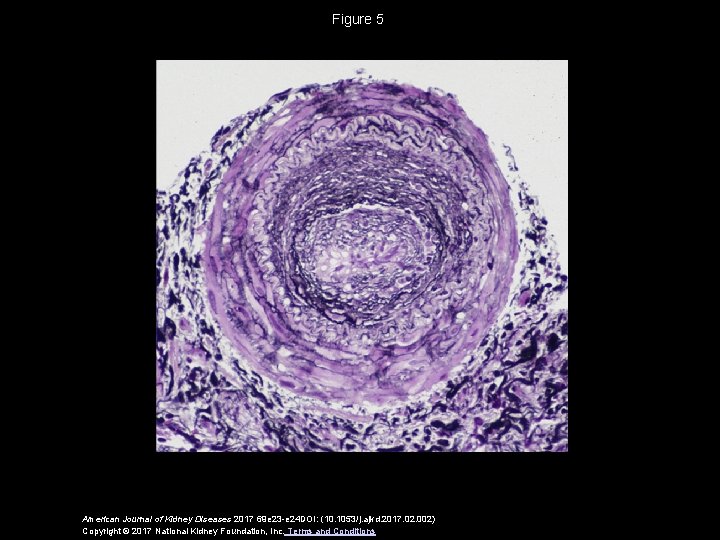 Figure 5 American Journal of Kidney Diseases 2017 69 e 23 -e 24 DOI: