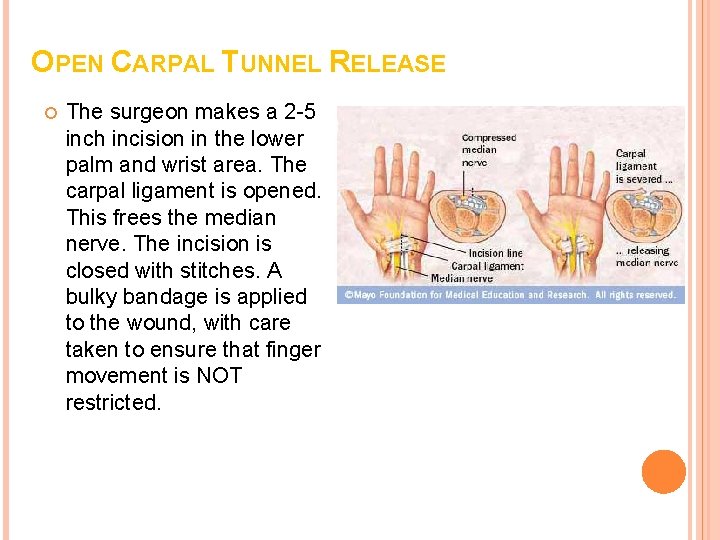 OPEN CARPAL TUNNEL RELEASE The surgeon makes a 2 -5 inch incision in the