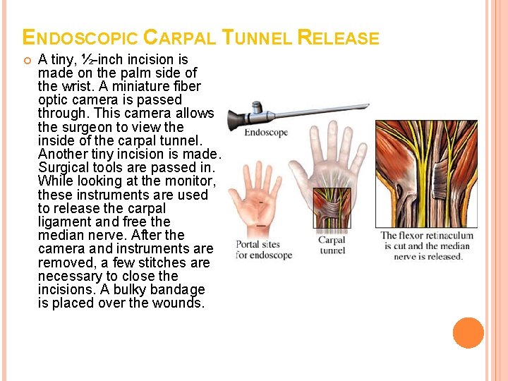 ENDOSCOPIC CARPAL TUNNEL RELEASE A tiny, ½-inch incision is made on the palm side