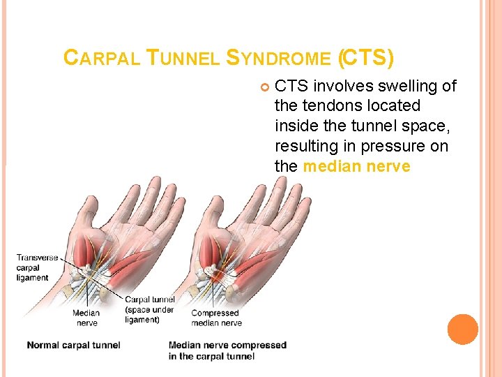 CARPAL TUNNEL SYNDROME (CTS) CTS involves swelling of the tendons located inside the tunnel