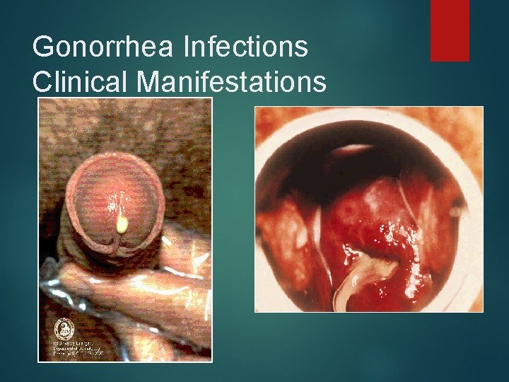 Gonorrhea Infections Clinical Manifestations 