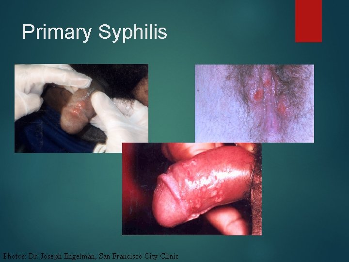 Primary Syphilis Photos: Dr. Joseph Engelman, San Francisco City Clinic 