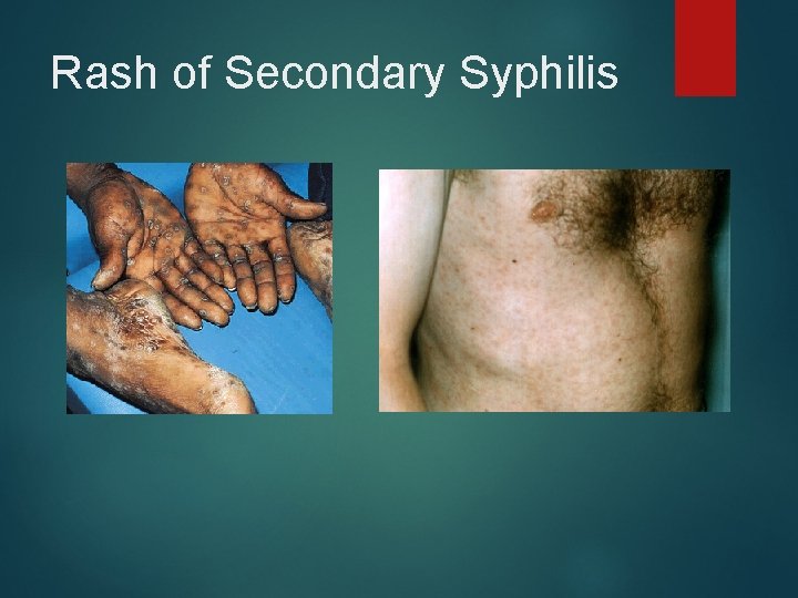 Rash of Secondary Syphilis 