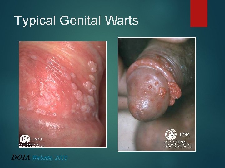 Typical Genital Warts DOIA Website, 2000 