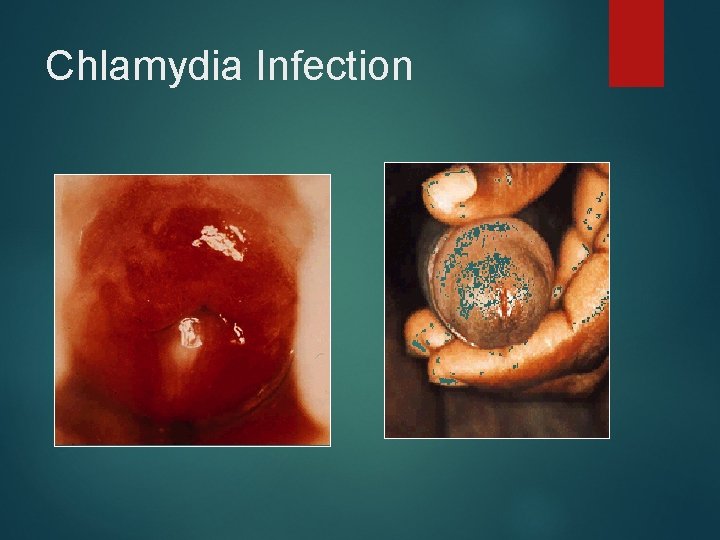 Chlamydia Infection 