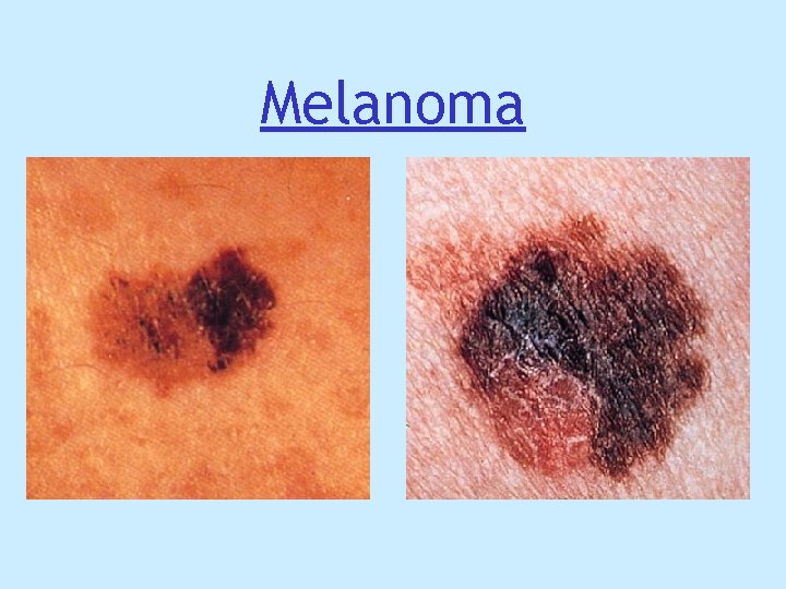Melanoma Melanoma