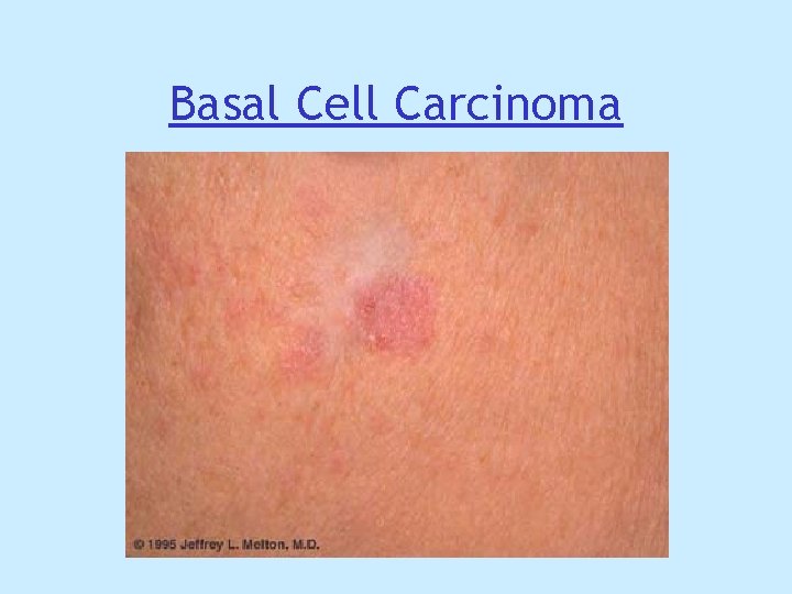 Basal Cell Carcinoma Basal Cell Carcinoma