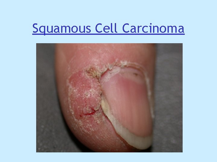 Squamous Cell Carcinoma Squamous Cell Carcinoma